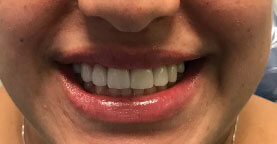 patients teeth after