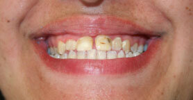 patients teeth before